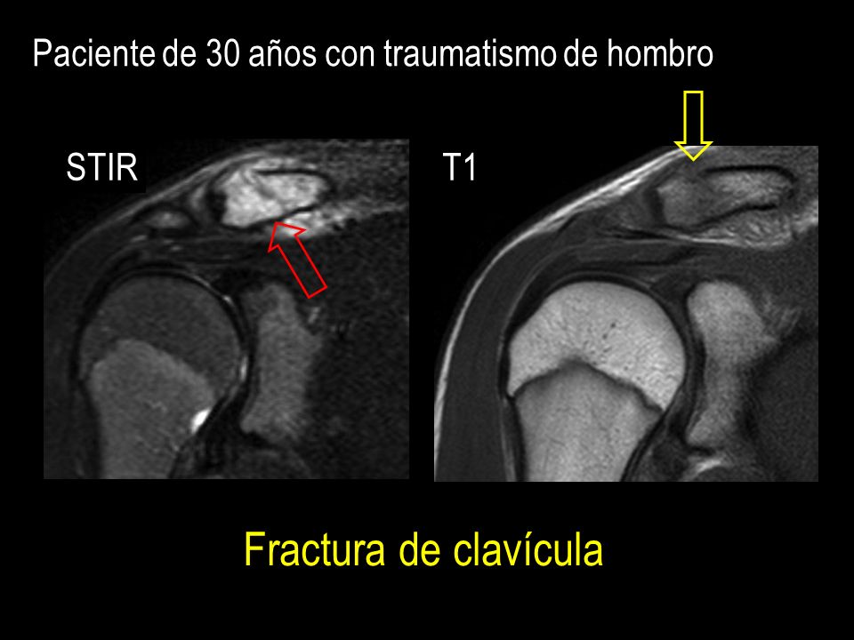 Fractura de clavícula Paciente de 30 años con traumatismo de hombro
