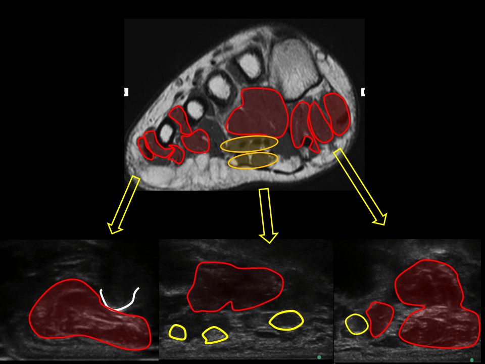 Evaluo los musculos En relacion al quinto dedo. Oponente pegado al hueso, abductor mas externo y flexor en region plantar.