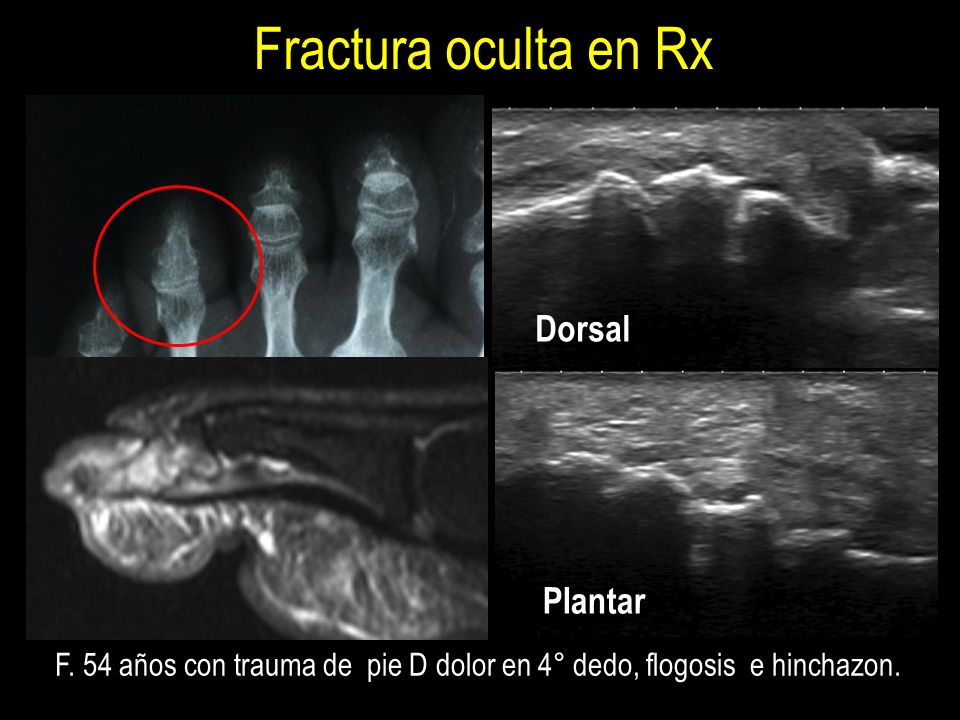 F. 54 años con trauma de pie D dolor en 4° dedo, flogosis e hinchazon.