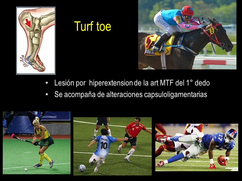 Turf toe Lesión por hiperextension de la art MTF del 1° dedo