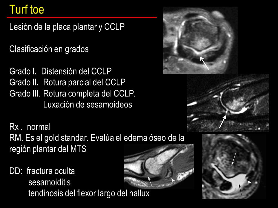 Turf toe Lesión de la placa plantar y CCLP Clasificación en grados
