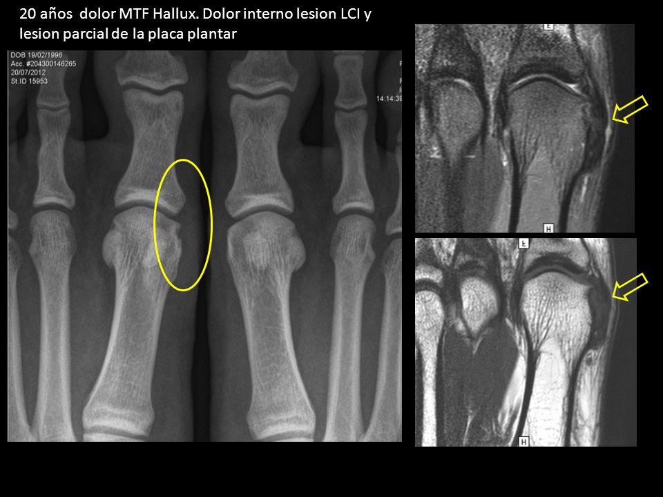 20 años dolor MTF Hallux. Dolor interno lesion LCI y lesion parcial de la placa plantar