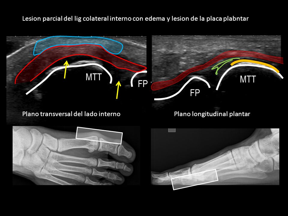 Lesion parcial del lig colateral interno con edema y lesion de la placa plabntar