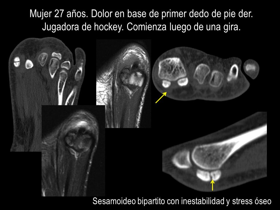 Mujer 27 años. Dolor en base de primer dedo de pie der