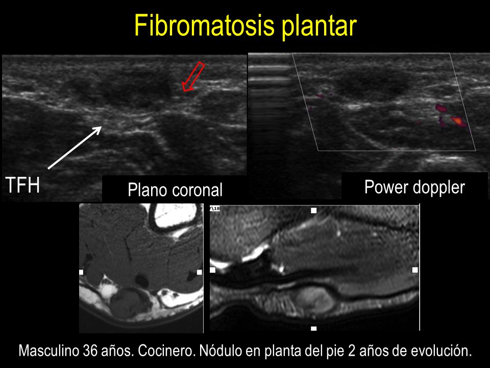 Fibromatosis plantar TFH Power doppler Plano coronal