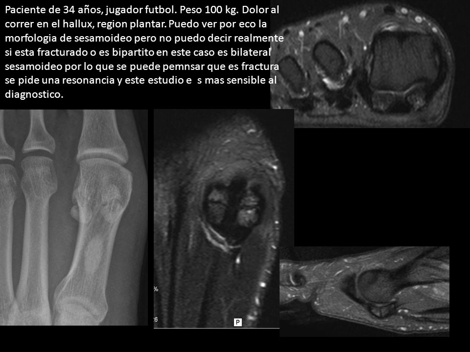 Paciente de 34 años, jugador futbol. Peso 100 kg