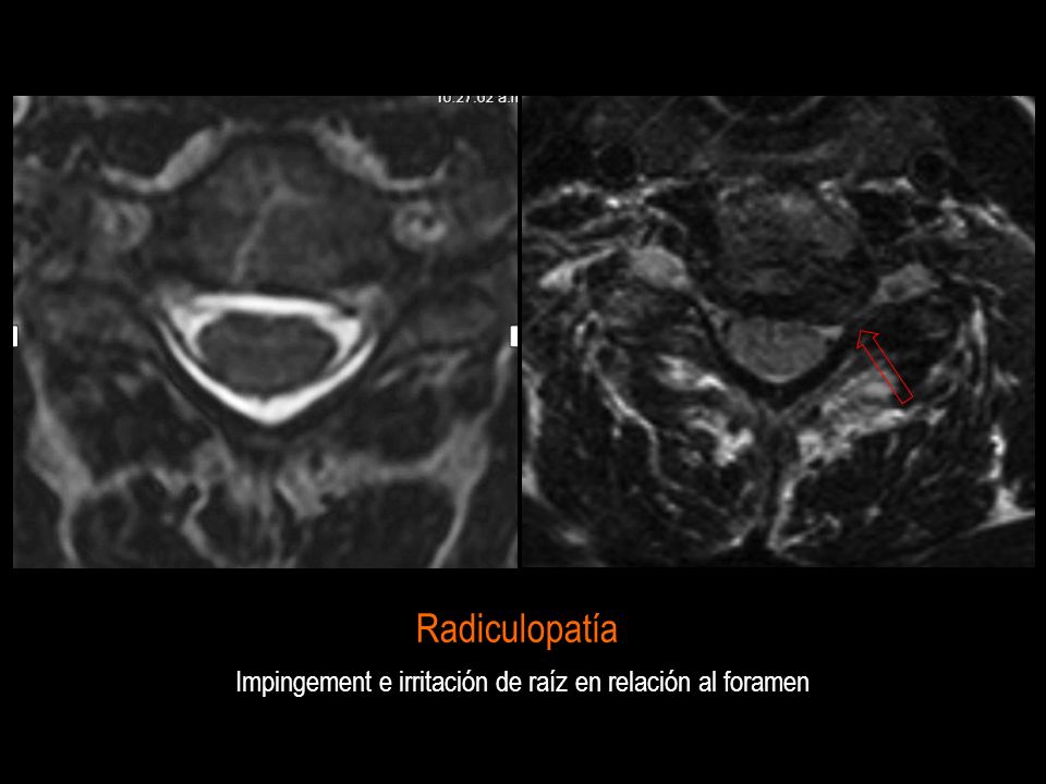 Impingement e irritación de raíz en relación al foramen