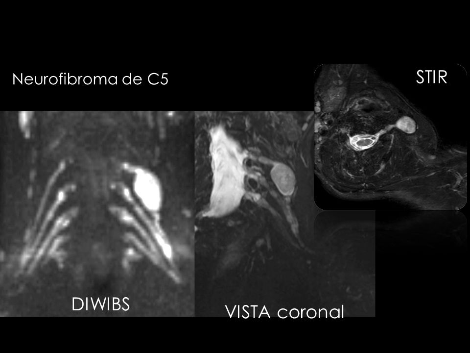 STIR Neurofibroma de C5 DIWIBS VISTA coronal