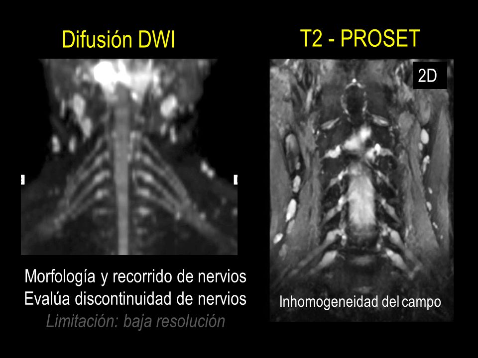 Difusión DWI T2 - PROSET 2D Morfología y recorrido de nervios