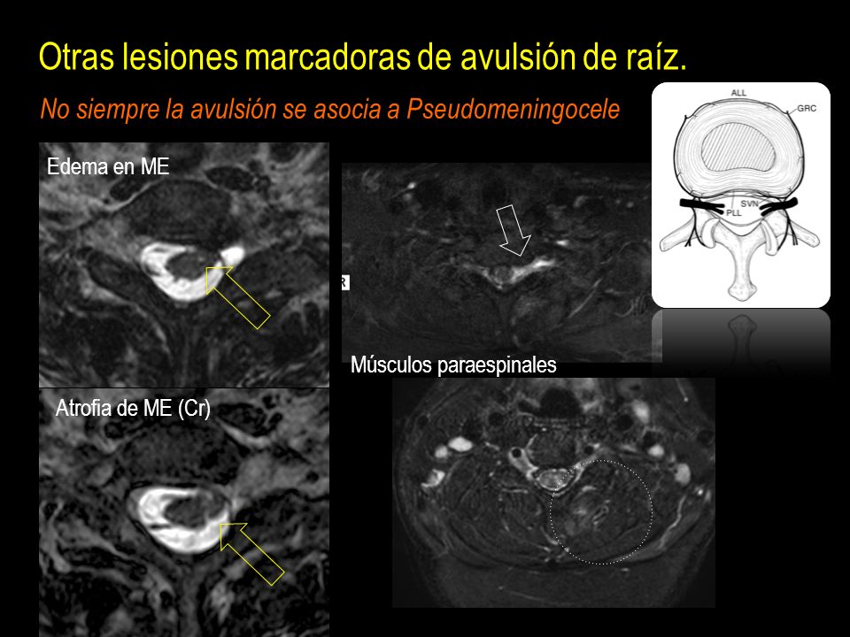 Otras lesiones marcadoras de avulsión de raíz.