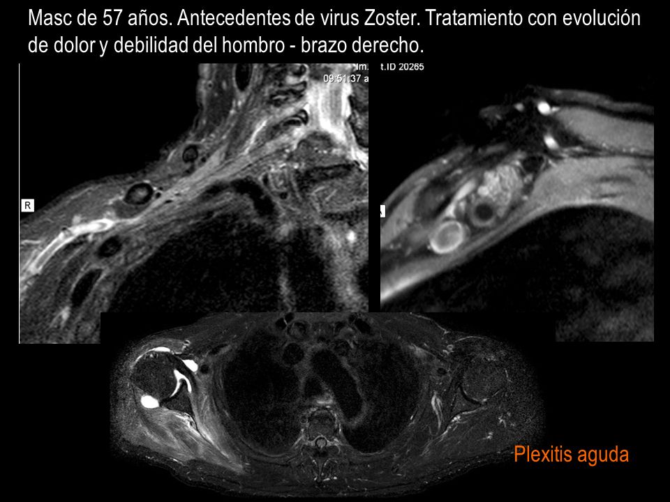 Masc de 57 años. Antecedentes de virus Zoster