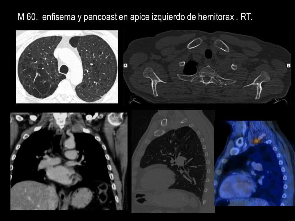 M 60. enfisema y pancoast en apice izquierdo de hemitorax . RT.