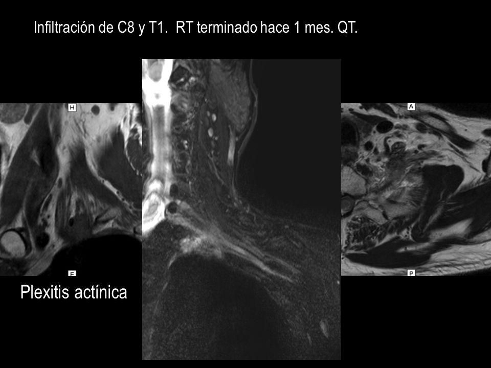 Infiltración de C8 y T1. RT terminado hace 1 mes. QT.