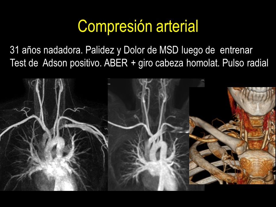 Compresión arterial 31 años nadadora. Palidez y Dolor de MSD luego de entrenar.