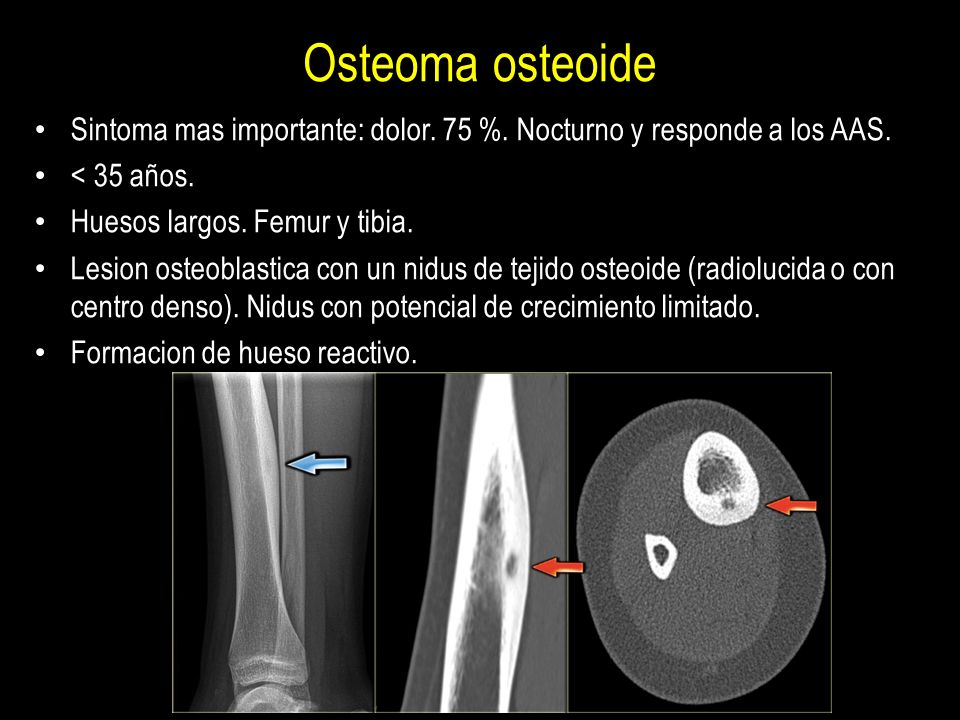 Osteoma osteoide Sintoma mas importante: dolor. 75 %. Nocturno y responde a los AAS. < 35 años. Huesos largos. Femur y tibia.