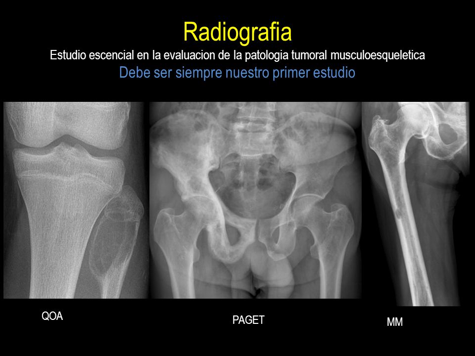 Radiografia Estudio escencial en la evaluacion de la patologia tumoral musculoesqueletica Debe ser siempre nuestro primer estudio