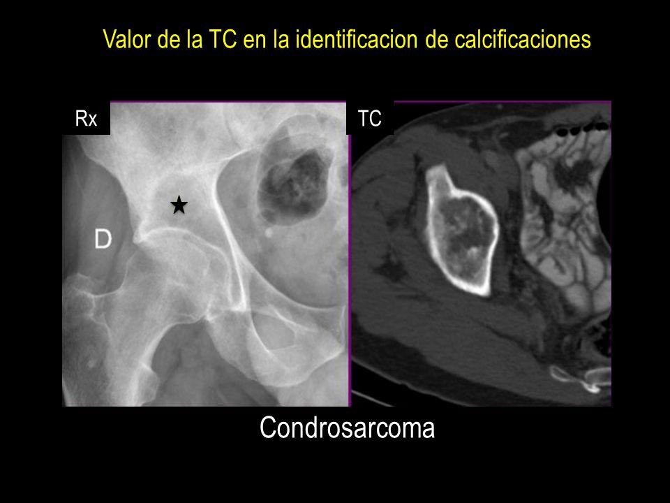 Condrosarcoma Valor de la TC en la identificacion de calcificaciones