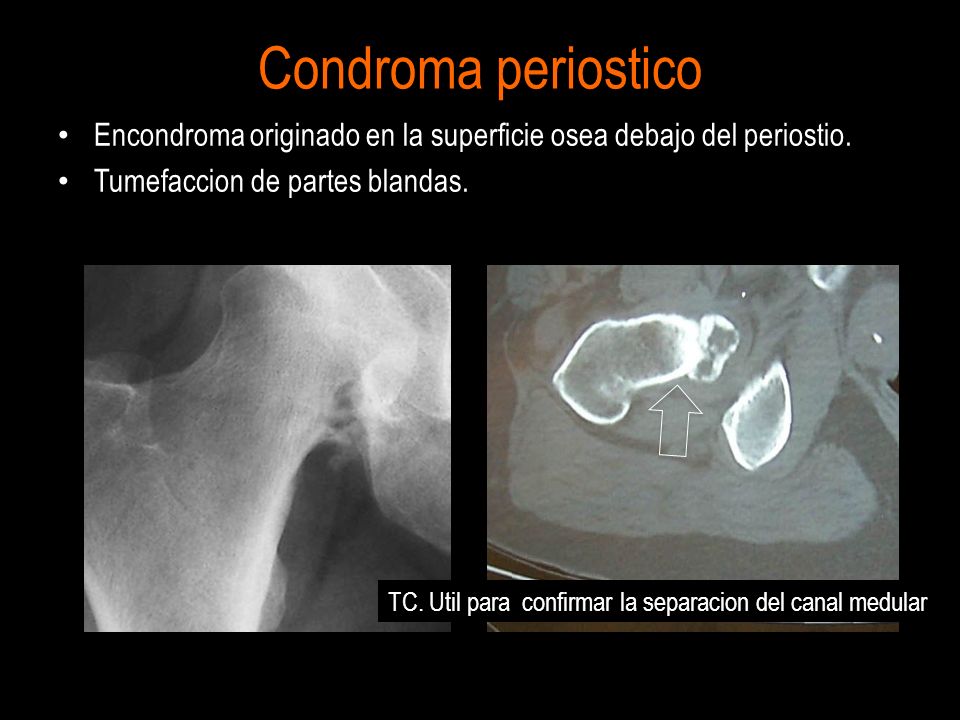 Condroma periostico Encondroma originado en la superficie osea debajo del periostio. Tumefaccion de partes blandas.