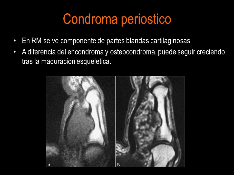 Condroma periostico En RM se ve componente de partes blandas cartilaginosas.