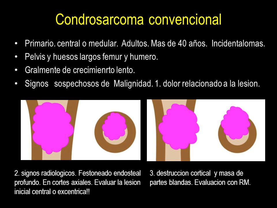 Condrosarcoma convencional