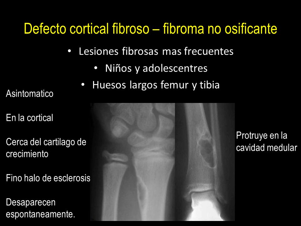 Defecto cortical fibroso – fibroma no osificante