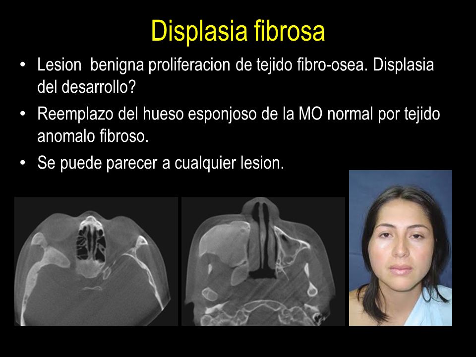 Displasia fibrosa Lesion benigna proliferacion de tejido fibro-osea. Displasia del desarrollo