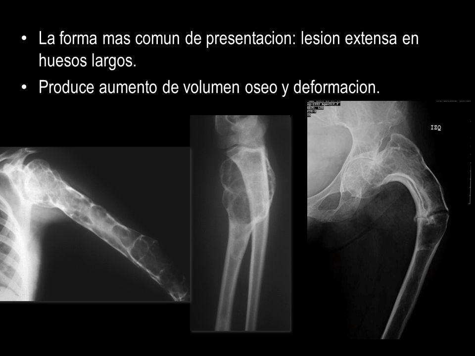La forma mas comun de presentacion: lesion extensa en huesos largos.