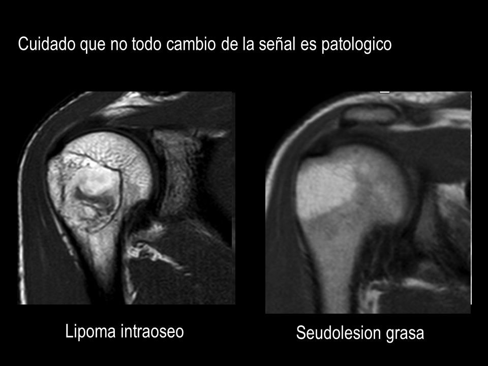 Cuidado que no todo cambio de la señal es patologico
