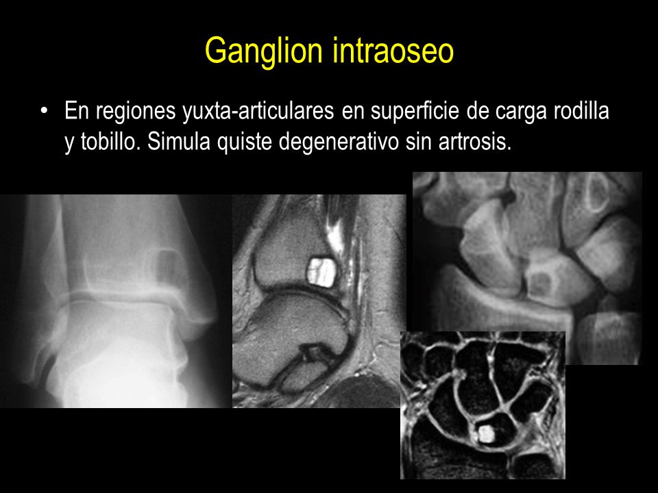 Ganglion intraoseo En regiones yuxta-articulares en superficie de carga rodilla y tobillo.
