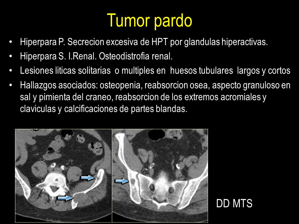 Tumor pardo Hiperpara P. Secrecion excesiva de HPT por glandulas hiperactivas. Hiperpara S. I.Renal. Osteodistrofia renal.