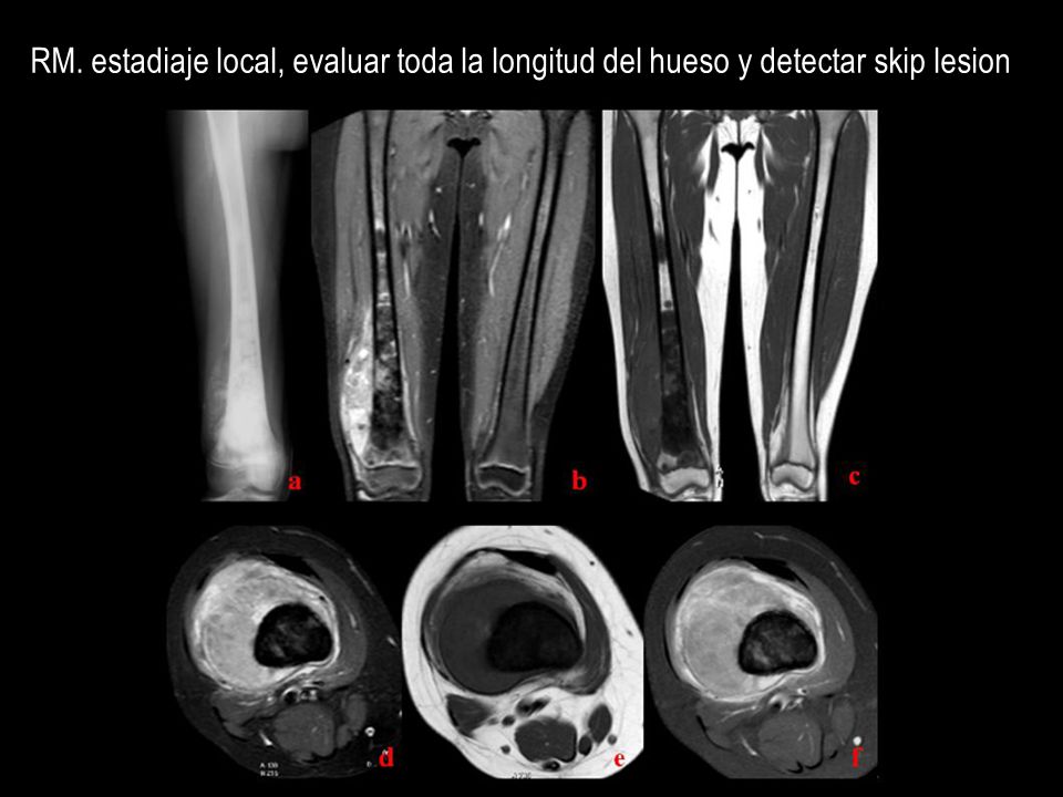 RM. estadiaje local, evaluar toda la longitud del hueso y detectar skip lesion