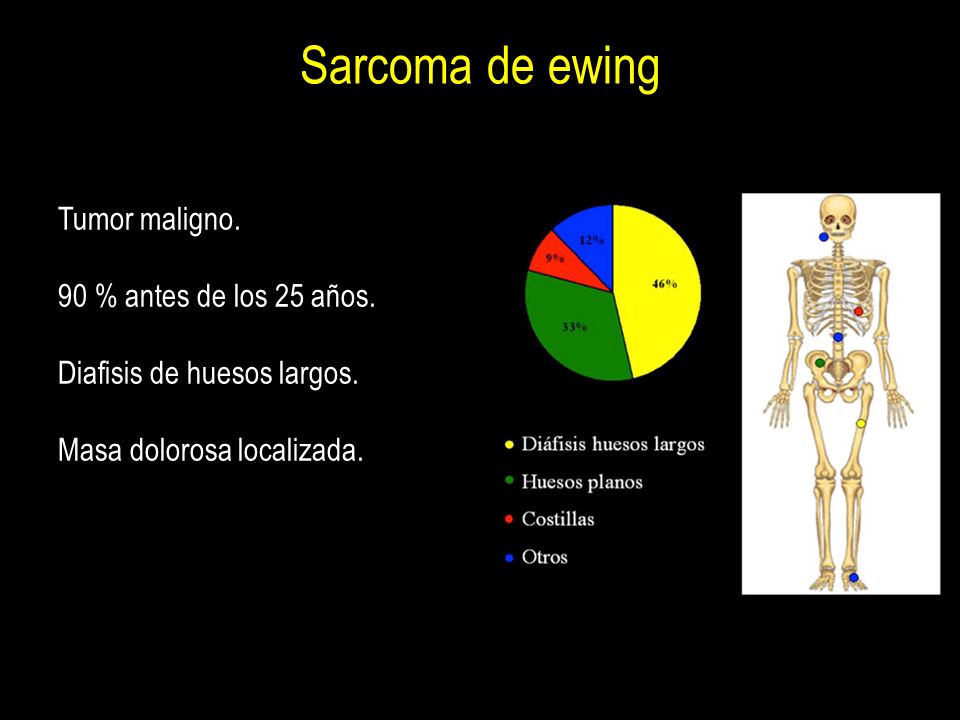 Sarcoma de ewing Tumor maligno. 90 % antes de los 25 años.