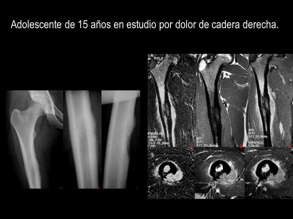 Adolescente de 15 años en estudio por dolor de cadera derecha.