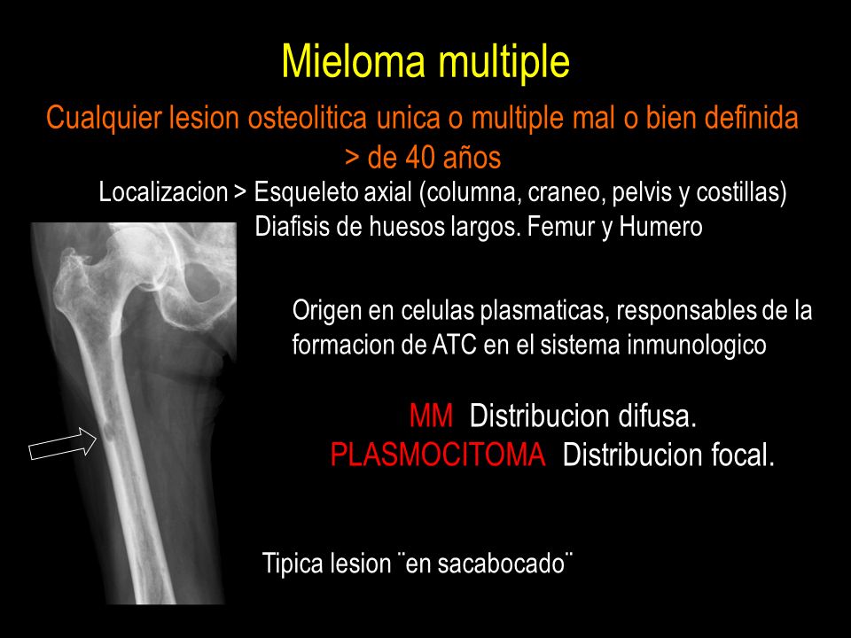 Mieloma multiple Cualquier lesion osteolitica unica o multiple mal o bien definida. > de 40 años.