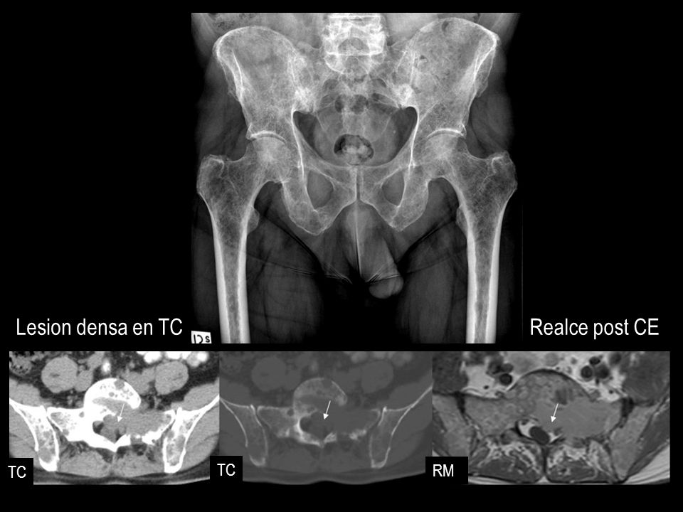 Lesion densa en TC Realce post CE TC TC RM
