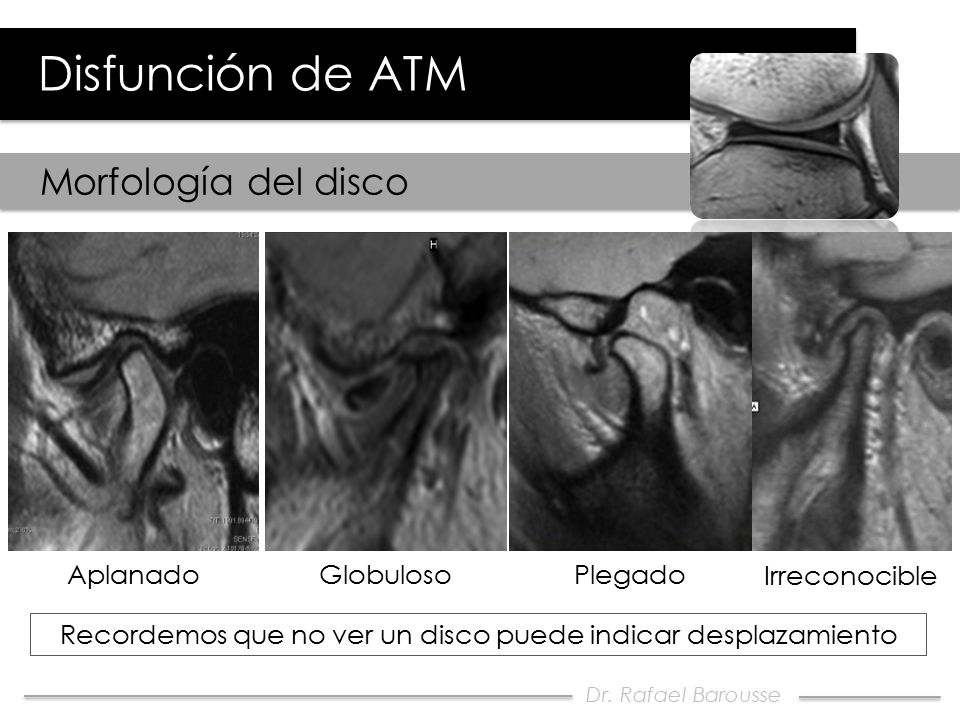 Recordemos que no ver un disco puede indicar desplazamiento