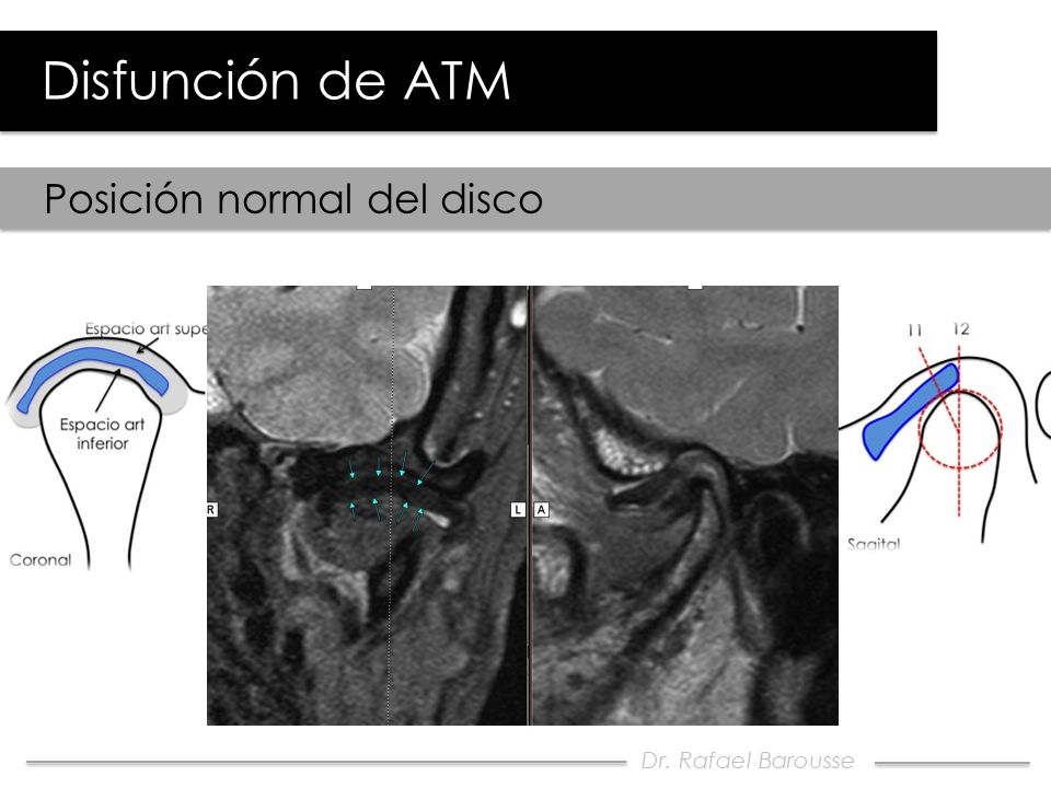 Disfunción de ATM Posición normal del disco Dr. Rafael Barousse