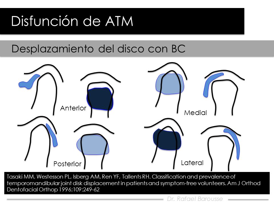 Disfunción de ATM Desplazamiento del disco con BC Anterior Medial