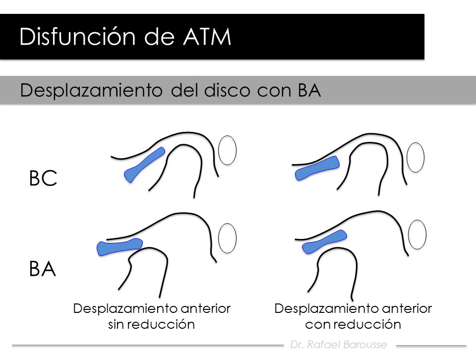 Disfunción de ATM BC BA Desplazamiento del disco con BA