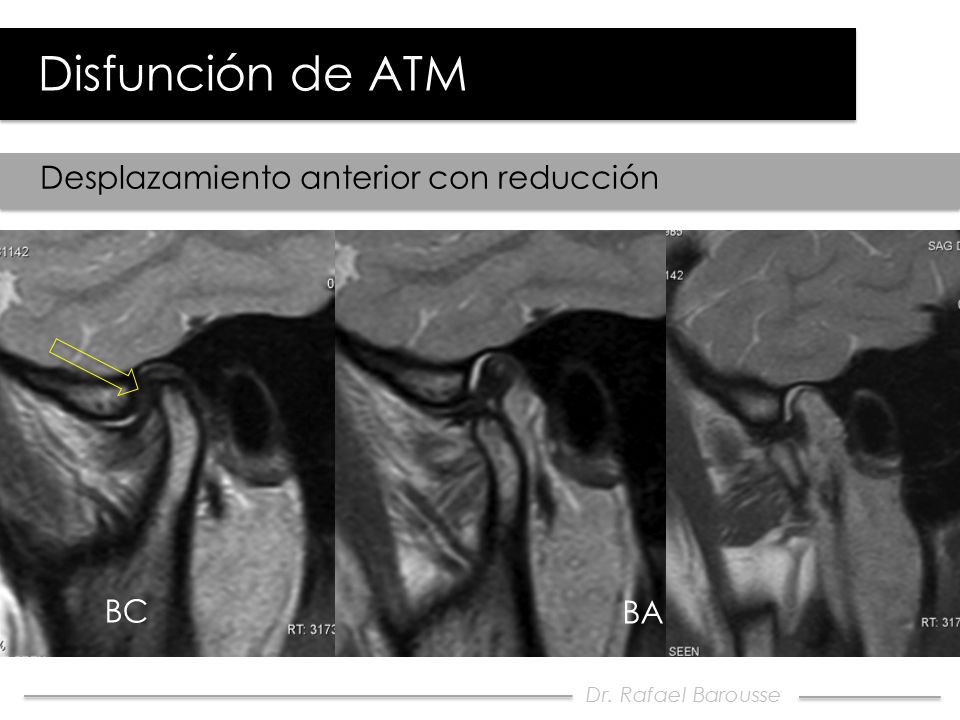 Disfunción de ATM Desplazamiento anterior con reducción BC BA
