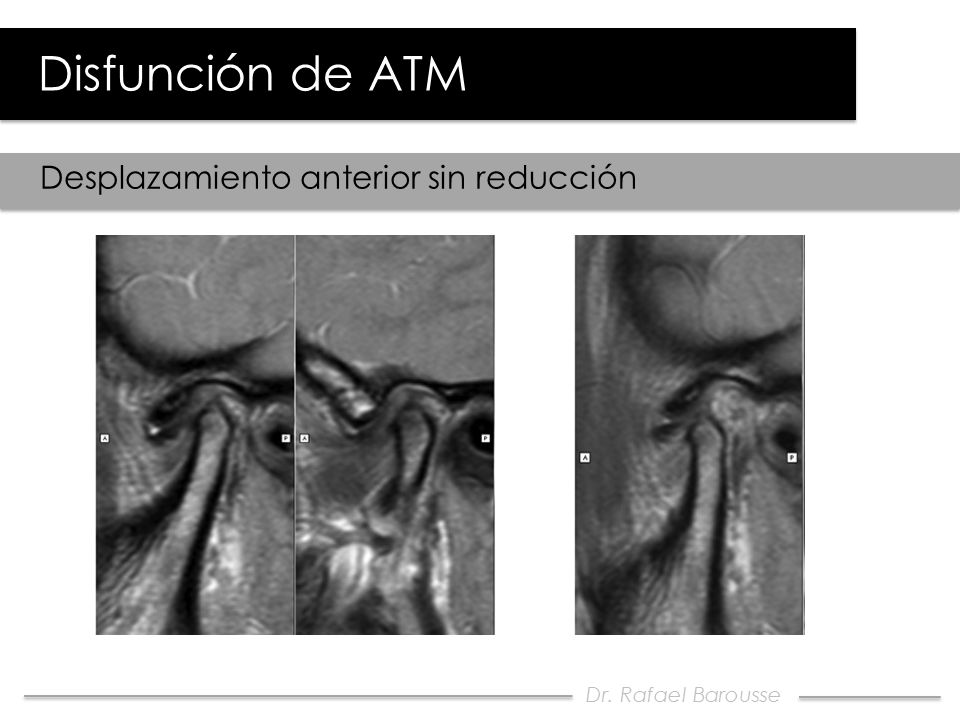 Disfunción de ATM Desplazamiento anterior sin reducción BC BA