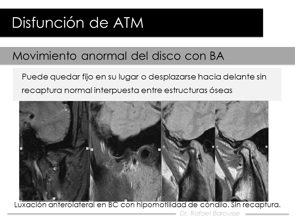 Disfunción de ATM Movimiento anormal del disco con BA