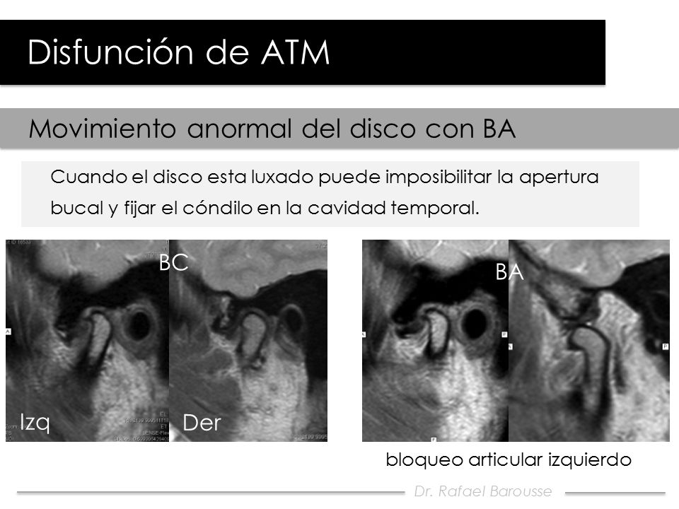 Disfunción de ATM Movimiento anormal del disco con BA BC BA Izq Der