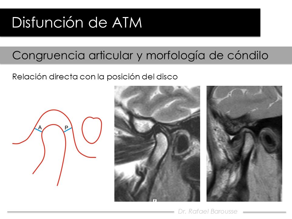 Disfunción de ATM Congruencia articular y morfología de cóndilo