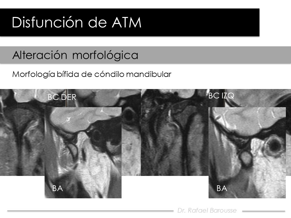 Disfunción de ATM Alteración morfológica