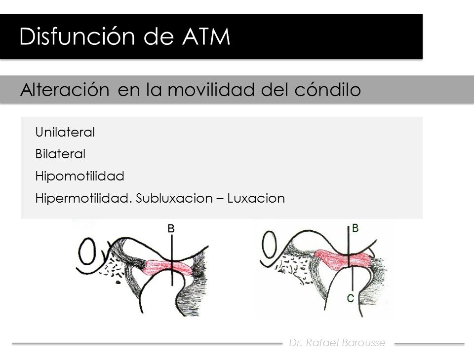 Disfunción de ATM Alteración en la movilidad del cóndilo Unilateral