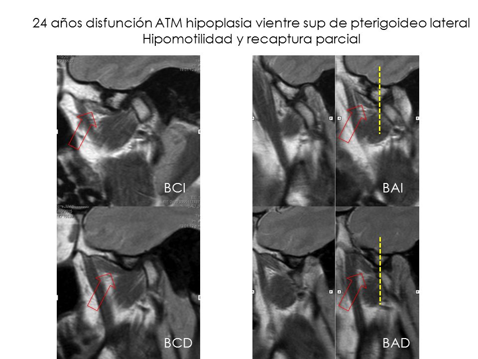 24 años disfunción ATM hipoplasia vientre sup de pterigoideo lateral