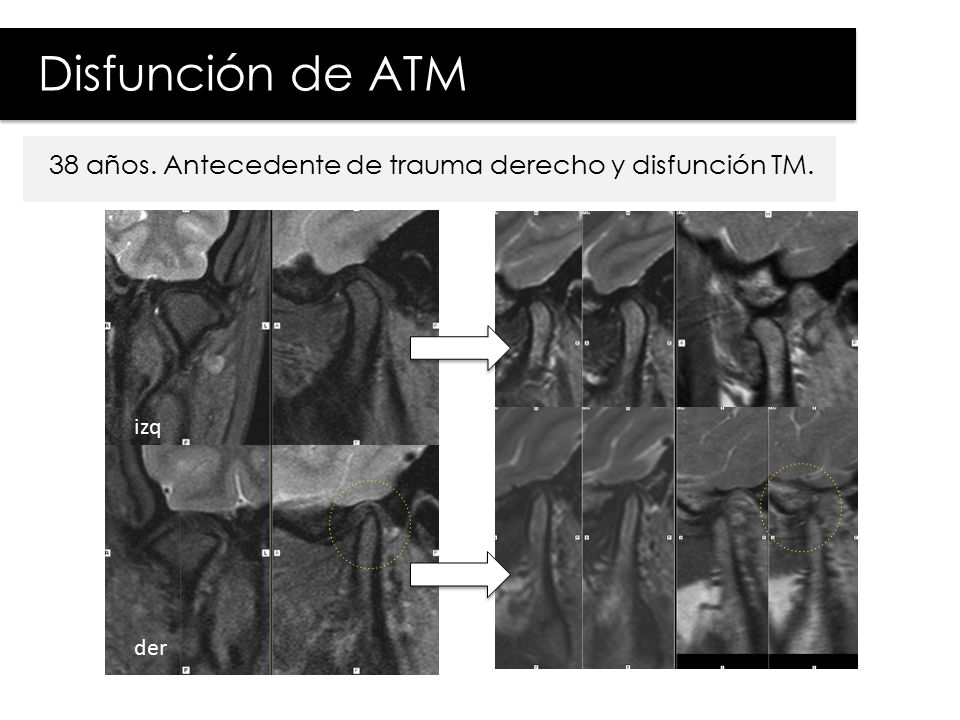 Disfunción de ATM 38 años. Antecedente de trauma derecho y disfunción TM. izq der