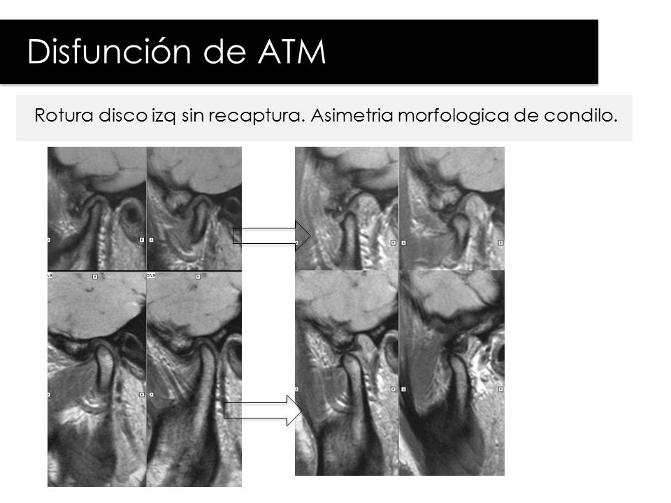 Disfunción de ATM Rotura disco izq sin recaptura. Asimetria morfologica de condilo.