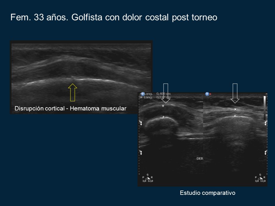 Fem. 33 años. Golfista con dolor costal post torneo